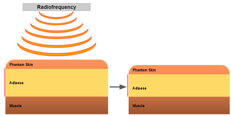 Image of Thermal body contouring class=